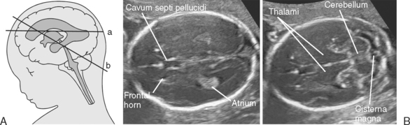 ULTRASOUND EVALUATION OF THE FETAL NEURAL AXIS | Radiology Key
