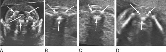 ULTRASOUND EVALUATION OF THE FETAL NEURAL AXIS | Radiology Key