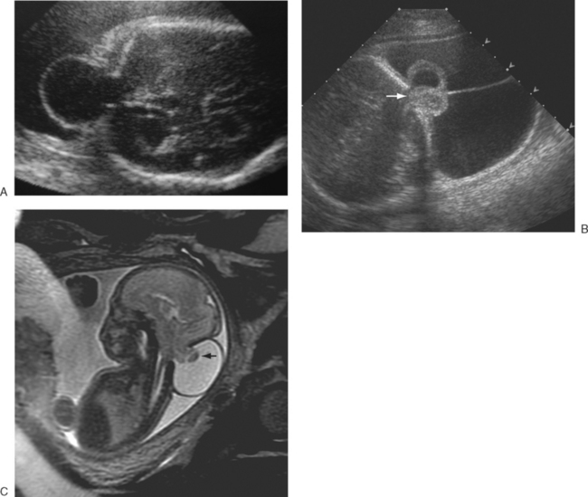 ULTRASOUND EVALUATION OF THE FETAL NEURAL AXIS | Radiology Key