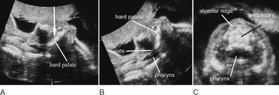 ULTRASOUND EVALUATION OF THE FETAL FACE AND NECK | Radiology Key