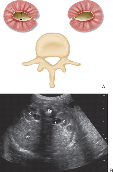 The Fetal Genitourinary Tract Radiology Key 6344