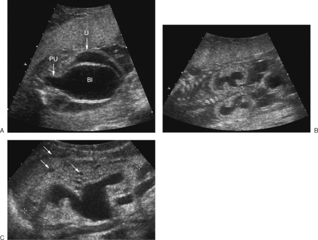 The Fetal Genitourinary Tract Radiology Key