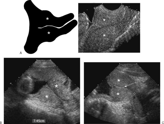 Ultrasound Evaluation Of The Cervix Radiology Key 