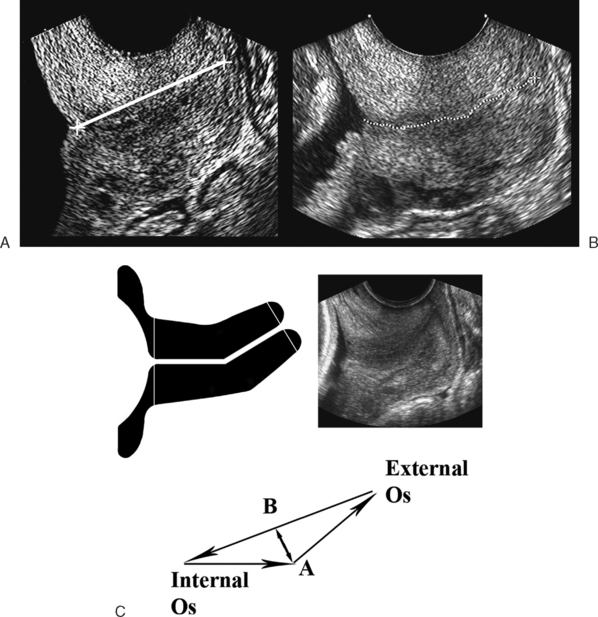 ULTRASOUND EVALUATION OF THE CERVIX Radiology Key