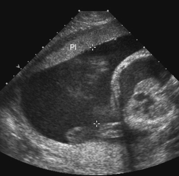 ULTRASOUND EVALUATION OF THE PLACENTA AND UMBILICAL CORD ...