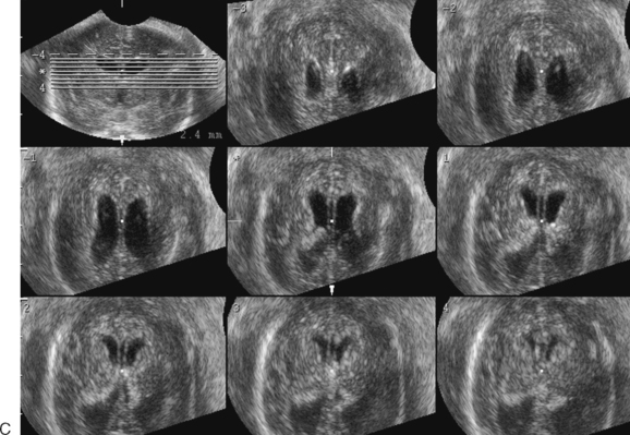 The Role Of Three Dimensional Ultrasound In The Evaluation Of The Fetus Radiology Key