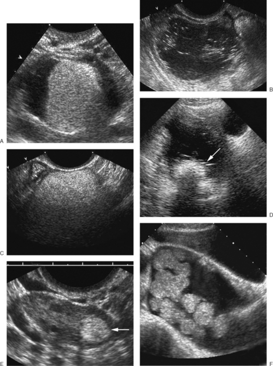 Ultrasound Evaluation Of The Adnexa Ovary And Fallopian Tubes