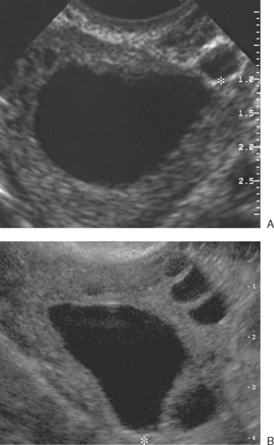 Ultrasonographic Imaging In Infertility Radiology Key 3003