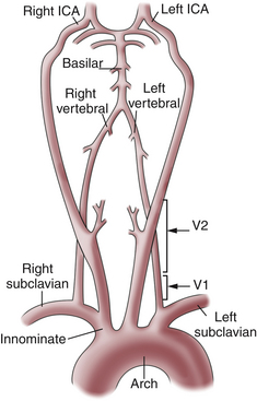 dominant left vertebral artery symptoms