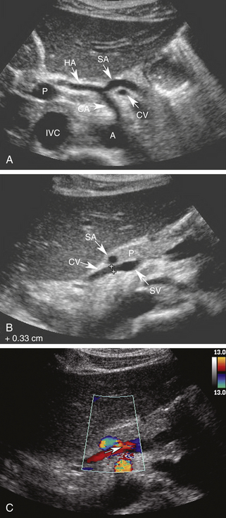 ultrasound assessment of the hepatic vasculature