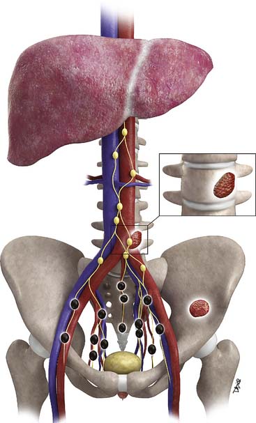 Prostate Cancer Radiology Key