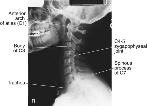 Spine | Radiology Key
