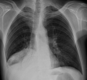 Pulmonary Lobar Collapse | Radiology Key