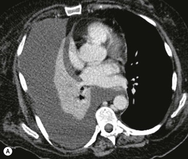 Pulmonary Lobar Collapse | Radiology Key