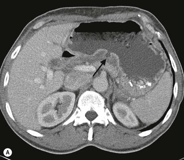 The Stomach | Radiology Key