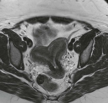 Benign Gynaecological Disease | Radiology Key