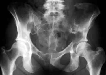 bone lytic tumours radiology radiograph metastases pelvis breast multiple showing ap figure