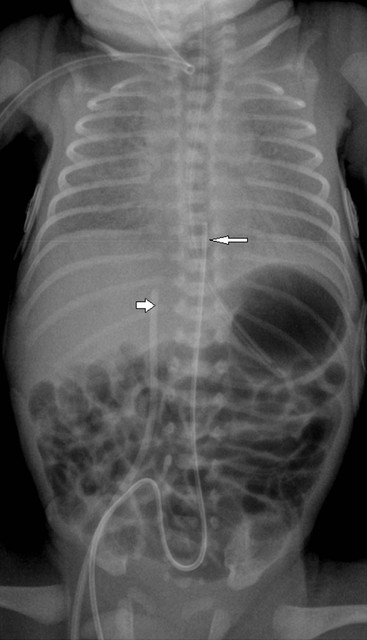 The Neonatal and Paediatric Chest | Radiology Key