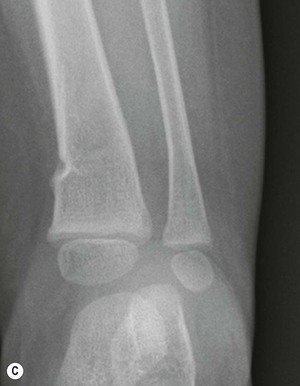 left radius and ulna shaft fracture icd 10