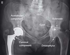 Hip and pelvis XR classic cases | Radiology Key