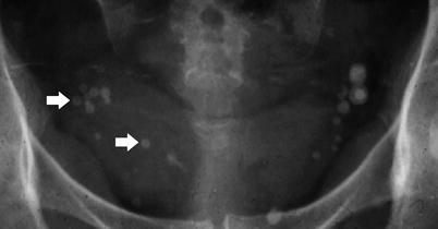 radiology pelvic fig multiple nephrolithiasis radiologykey