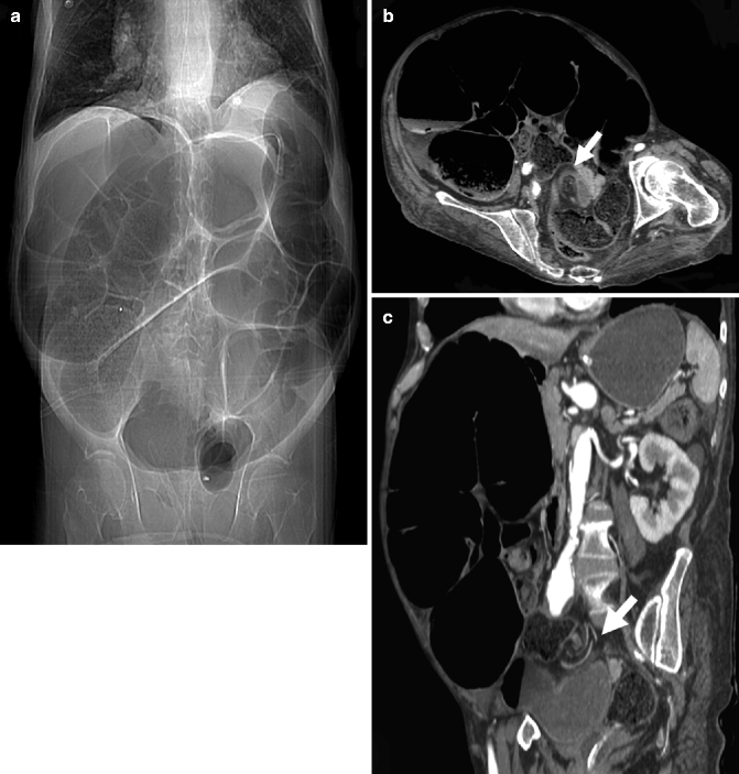 Bowel Obstruction Radiology Key