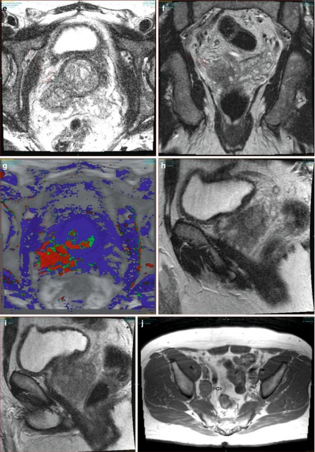 Focal Laser Ablation Of The Prostate Radiology Key