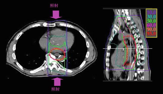 Esophageal Cancer Radiology Key