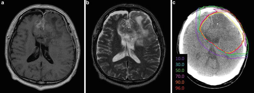 Brain Tumors Radiology Key