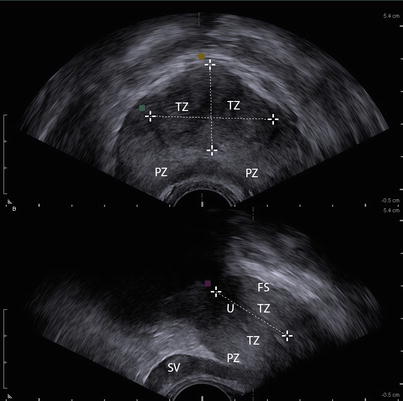 Prostate Zones Ultrasound