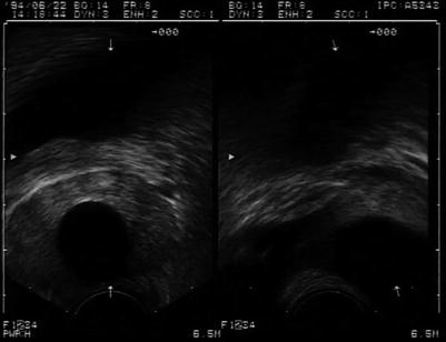 Transrectal Ultrasound of the Prostate | Radiology Key