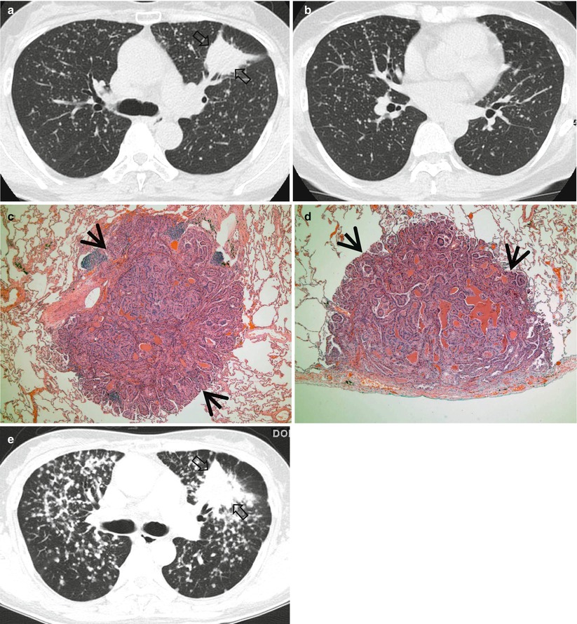 Small Nodules Radiology Key