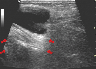 Fundamentals Of Musculoskeletal Ultrasound Radiology Key