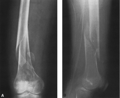Traumatic Lesions of Bones and Joints | Radiology Key