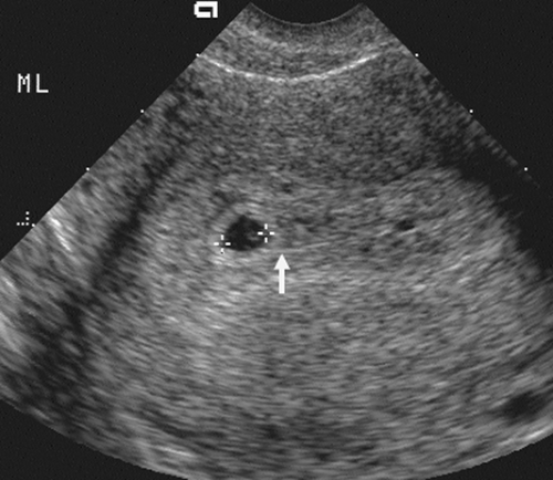 Is It Normal To Not See Yolk Sac At 5 Weeks