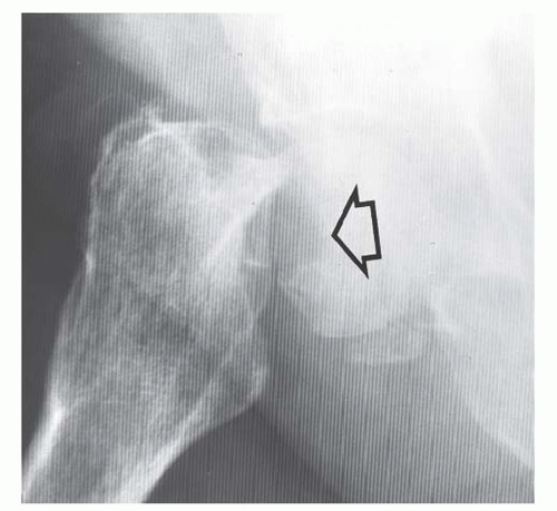 Imaging Thoracolumbar Spine Trauma Radiology Key