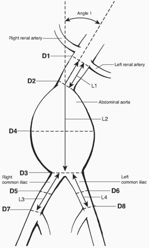 Abdominal Aortic Aneurysms Radiology Key