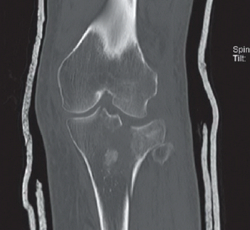 Tibial Plateau Fracture with Meniscal Entrapment | Radiology Key