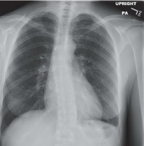 Rib Fracture with Hemopneumothorax | Radiology Key