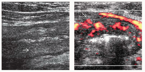 Infectious Colitis Radiology Key