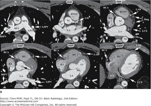 Chapter 3. Imaging of the Heart and Great Vessels | Radiology Key