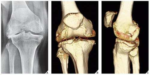 Degenerative Joint Disease | Radiology Key