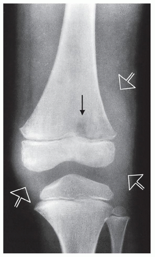 Osteomyelitis, Infectious Arthritis, and Soft-Tissue Infections