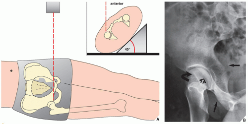 Lower Limb I: Pelvic Girdle, Sacrum, and Proximal Femur | Radiology Key