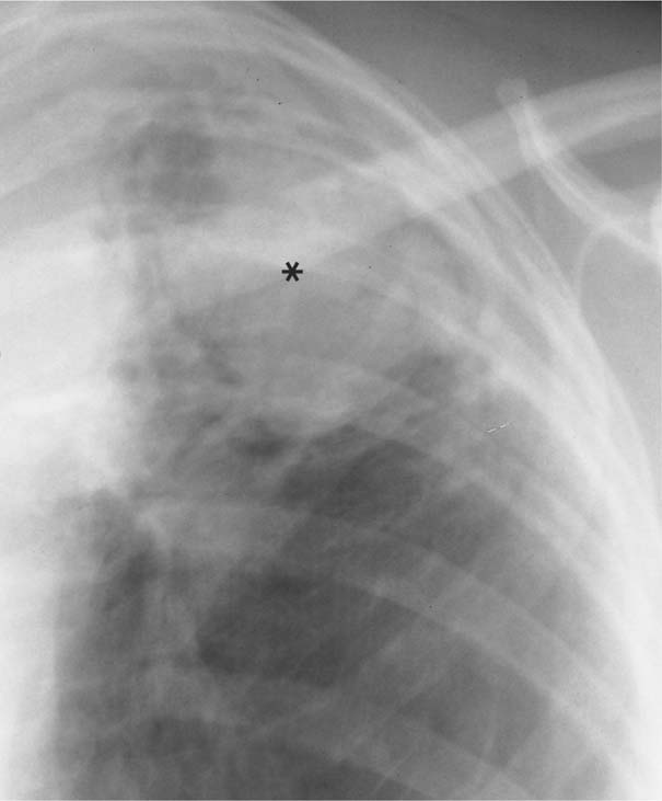 Pulmonary Cavitary And Cystic Lesions Radiology Key