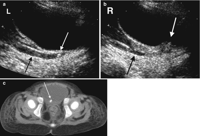 Urolithiasis Radiology Key