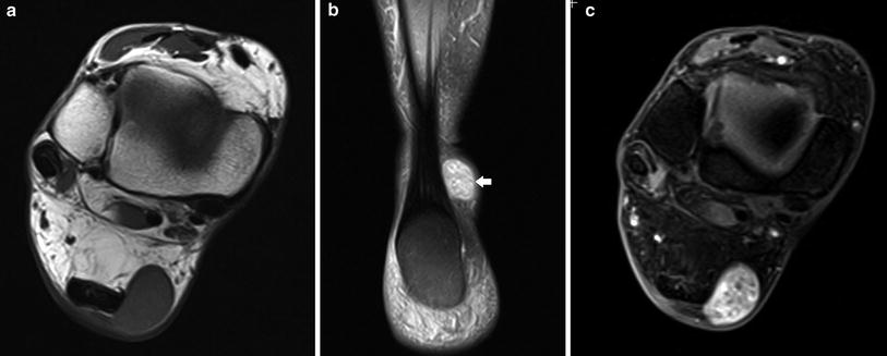 In Muscle Tumors And Tumors Of Fasciae And Tendon Sheaths Radiology Key
