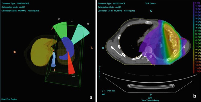 Primary Bone Tumors Radiology Key