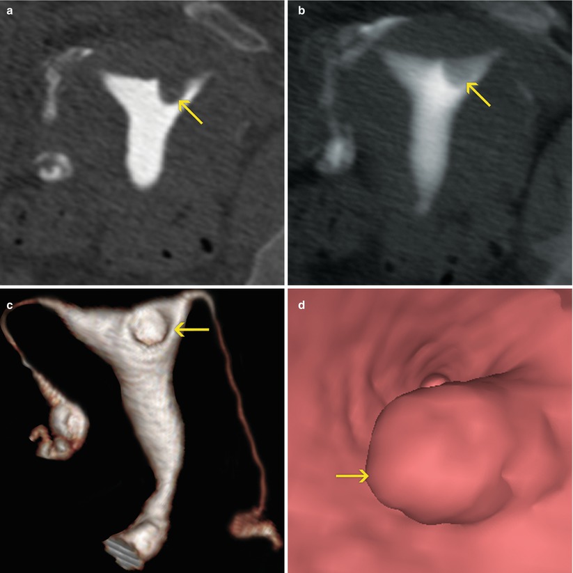 Pathology Of The Uterine Cavity Radiology Key 