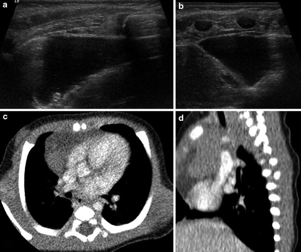 of the Pediatric Thymus and Thymic Disorders | Radiology Key